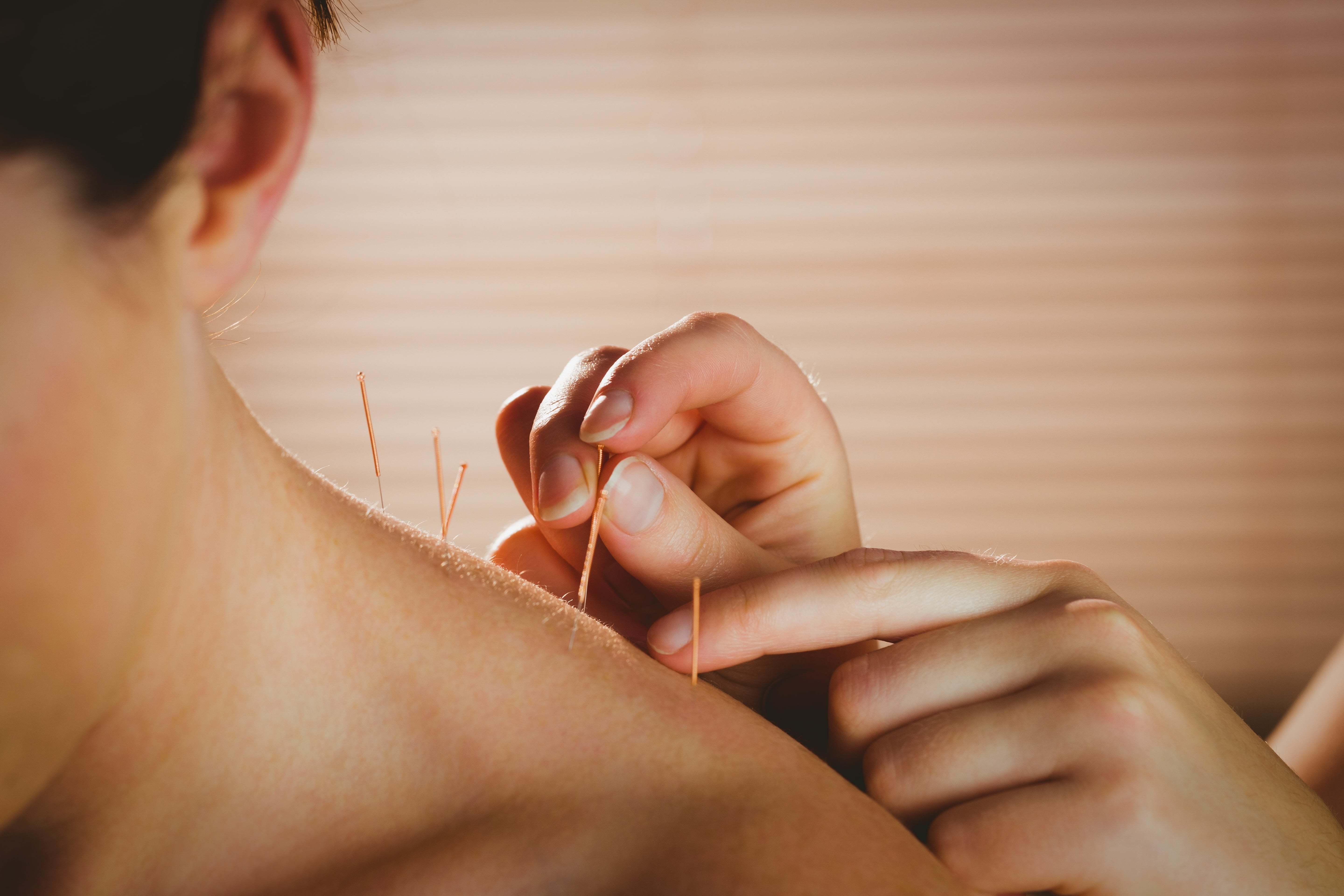 woman having acupuncture on back