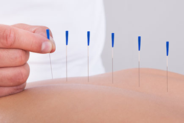 Dry Needling Treatment Newcastle